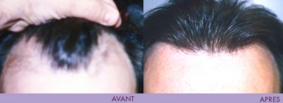 GREFFE DE CHEVEUX H & F