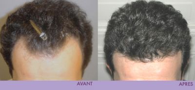 GREFFE DE CHEVEUX H & F